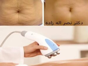 بهترین دستگاه لاغری شکم و تأثیر آن بر سلامت