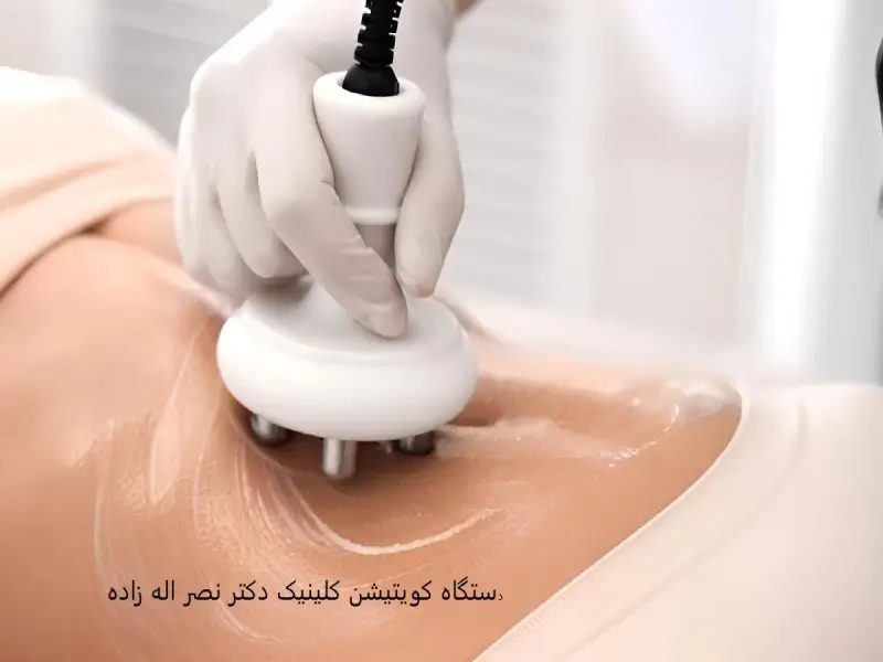 کدام دستگاه کویتیشن؟